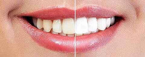 Teeth Whitening - Sandara Lara, DDS