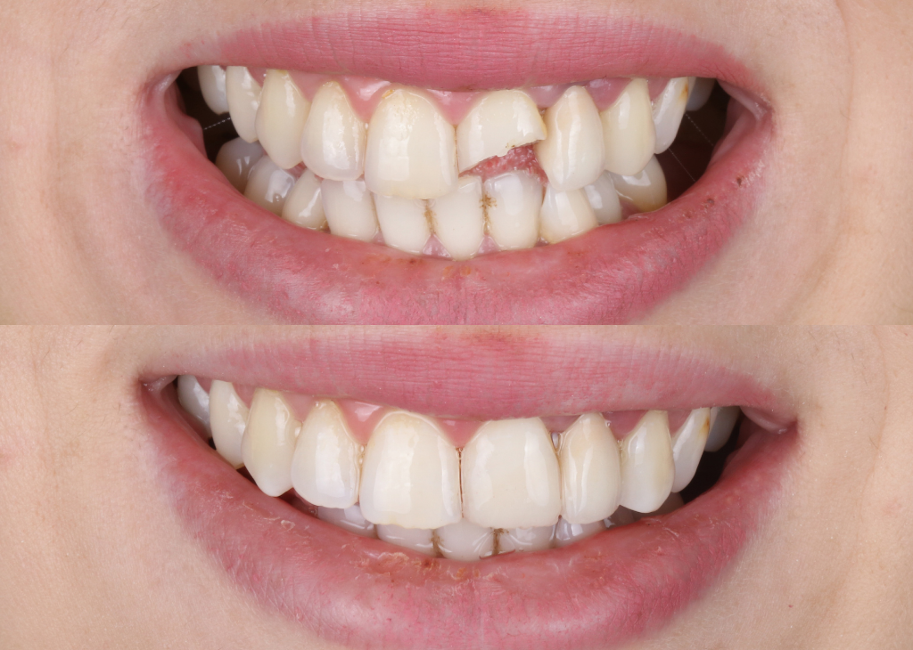 Dental Bonding Services at Sandra P Lara Dentistry