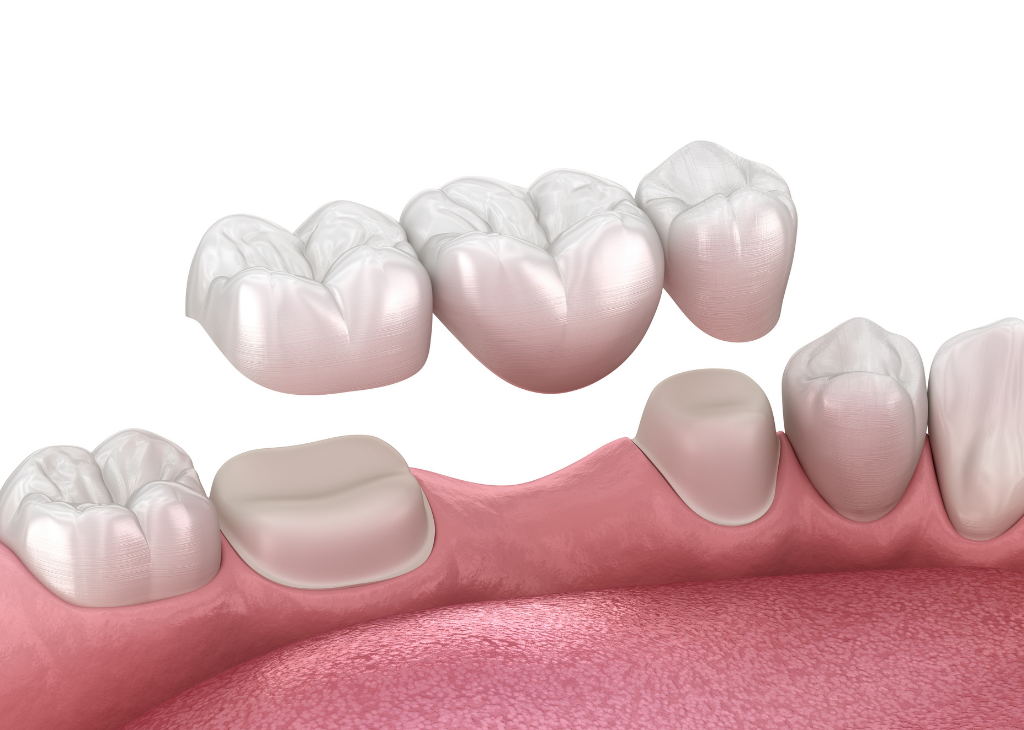 Dental Bridges at Sandra P Lara Dentistry