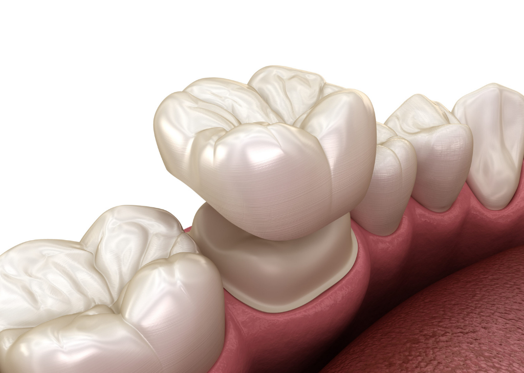 Dental Crowns at Sandra P Lara Dentistry