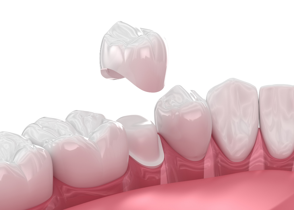 Porcelain Crown Services at Sandra P Lara Dentistry