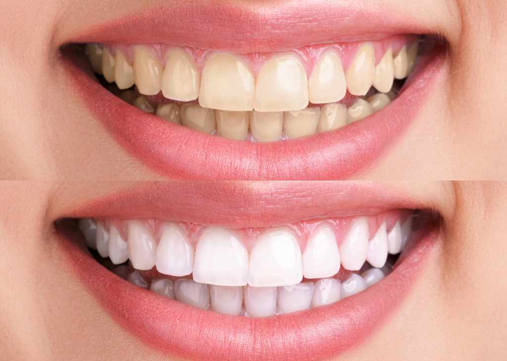 Teeth Whitening Services at Sandra P Lara Dentistry